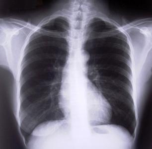 Mistenker du obstruktiv bronkitt? Symptomer bør være kjent for alle